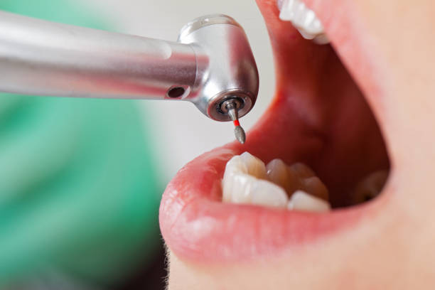 Best Emergency Root Canal Treatment in Scaggsville, MD